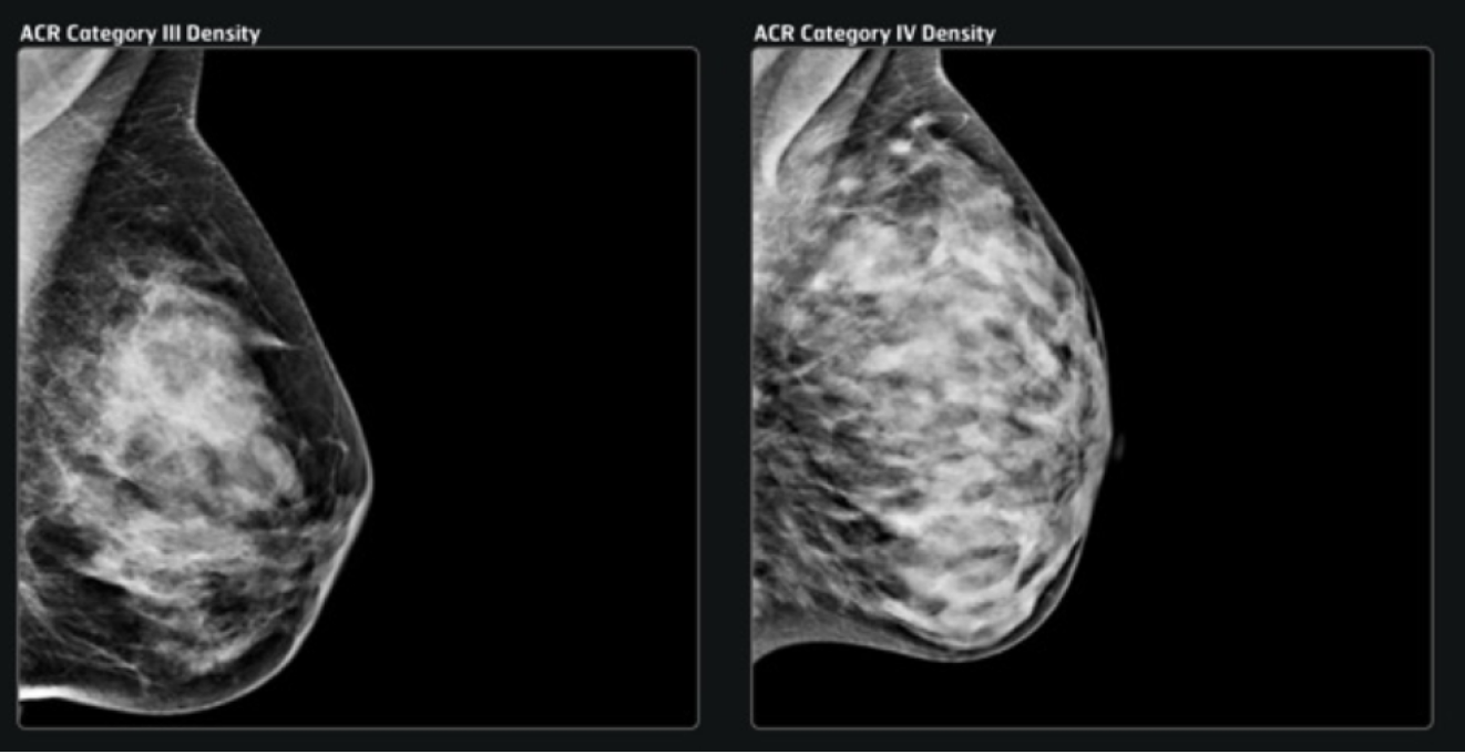 Information on breast composition from the DENSE trial