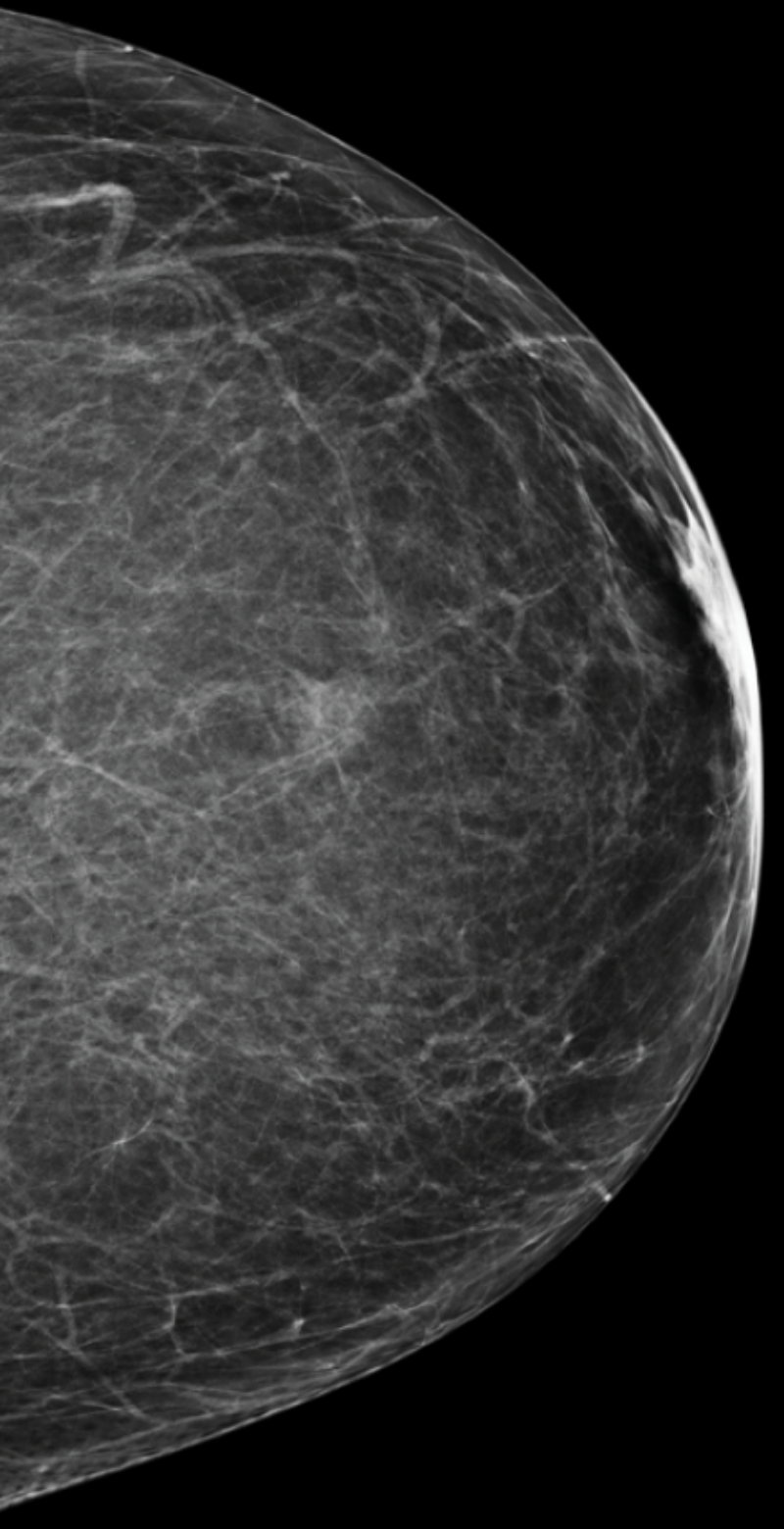 Mammogram with category a breast density