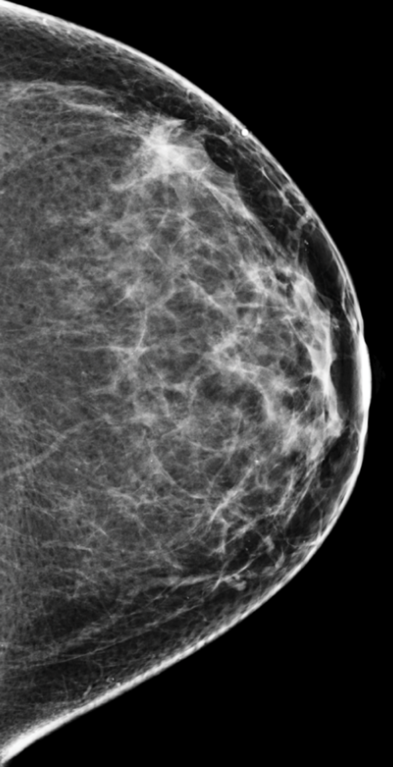 Mammogram with category b breast density