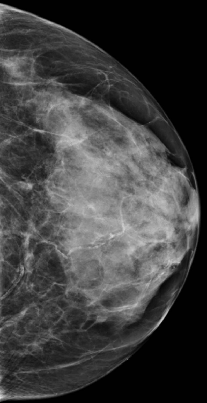 Mammogram with category c breast density