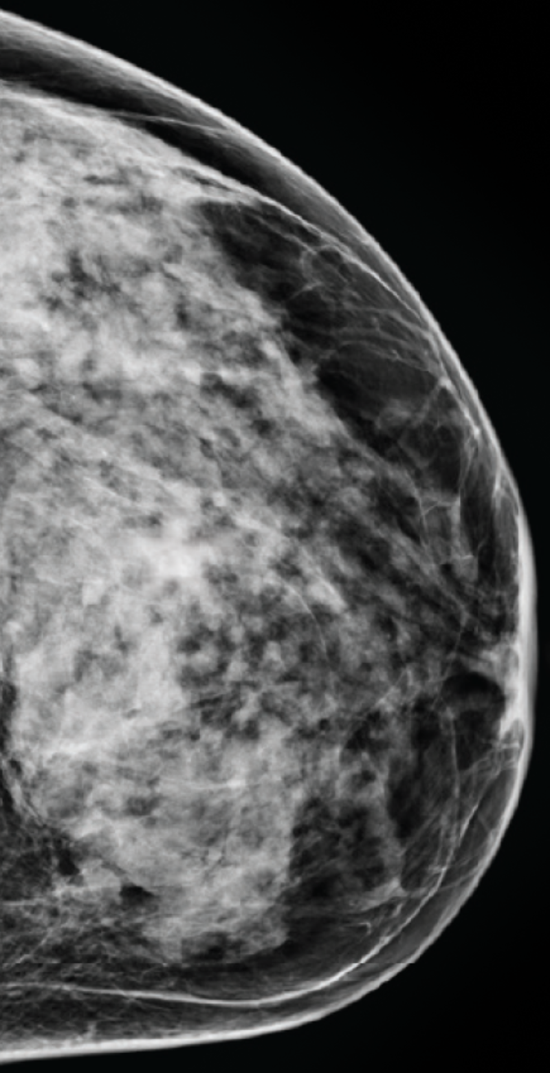 Mammogram with category d breast density