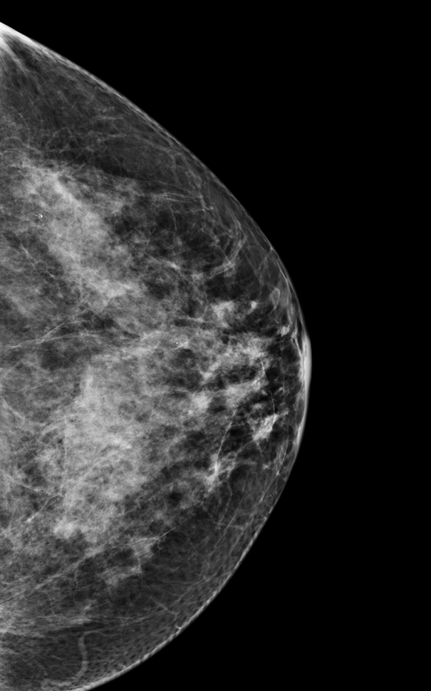 Mammogram with category c breast density