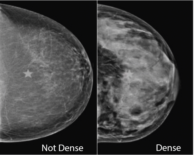 The Federal Breast Density Inform Rule: Huge Leap Forward, But
